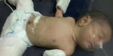 Dieser Bub kam &bdquo;schwanger&ldquo; zur Welt