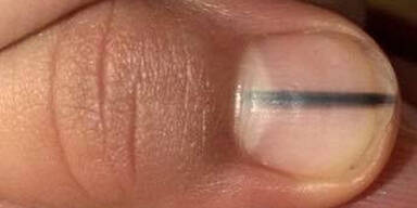 So gef&auml;hrlich kann ein Streifen unterm Fingernagel sein