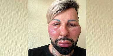 Gl&ouml;&ouml;ckler: Allergie wegen Beauty-OP?