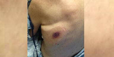 Fleischfressende Bakterien: Mann stirbt nach Bad im Meer