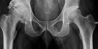 Dieser Mann hat einen Knochen im Penis