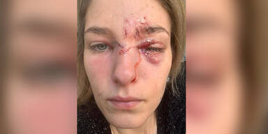 Hund bei&szlig;t Model ins Gesicht