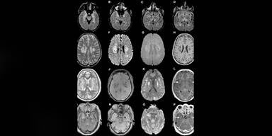Studie: Corona zerst&ouml;rt Gehirnzellen, Lunge erholt sich