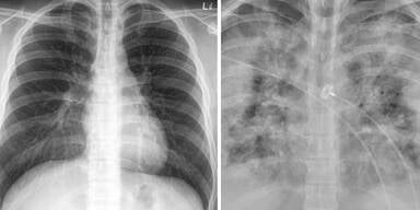 Fotos zeigen Corona-Lungen von Geimpften und Ungeimpften