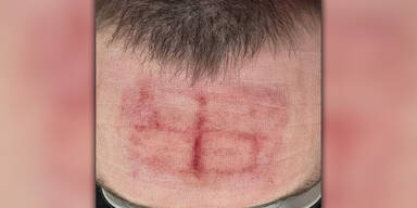 Russen ritzen Ukrainer Hakenkreuz in die Stirn