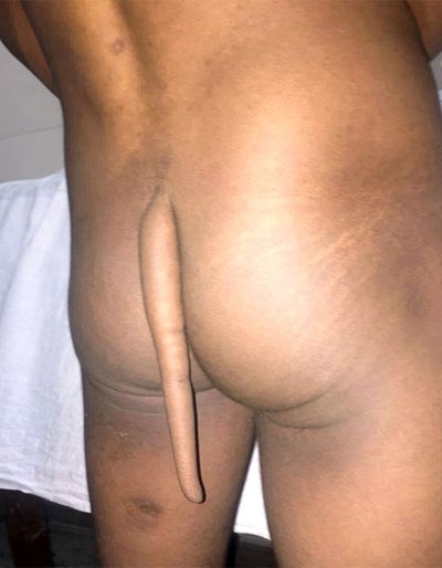 Ärzte entfernen Mann 18-Zentimeter-Schwanz