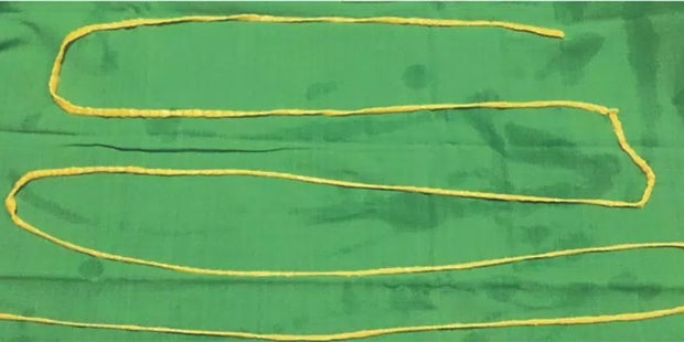 Ärzte ziehen 2-Meter-Bandwurm aus Mund eines Mannes