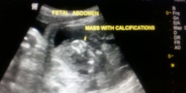 Dieser Bub kam „schwanger“ zur Welt