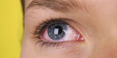 Warum Sie trockene Augen ernst nehmen sollten