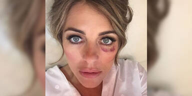 Liz Hurley mit Veilchen