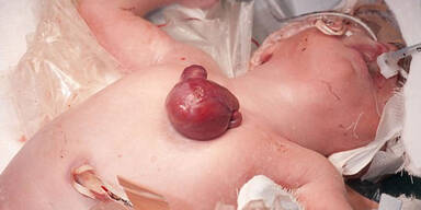 Baby kommt mit Au&szlig;en-Herz zur Welt