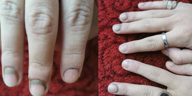 Schimmel Finger K&auml;rnten