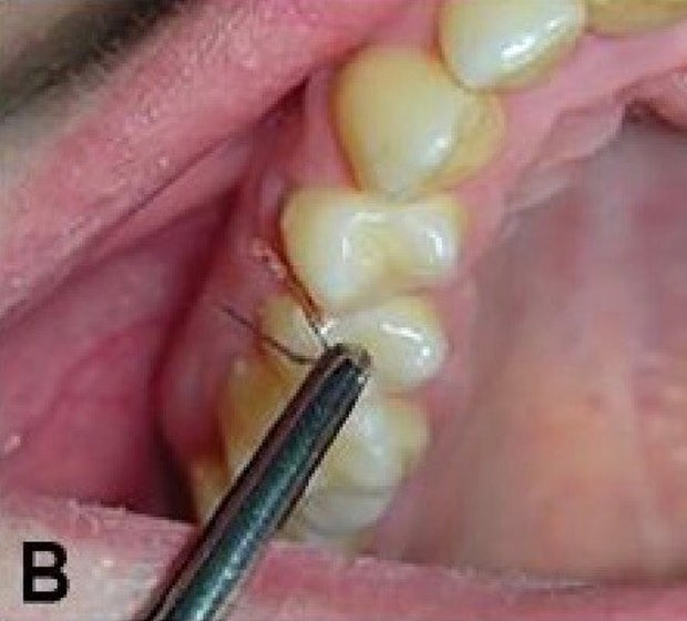 Frau (29) wachsen Haare auf den Zähnen