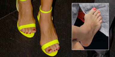 Hallux Valgus: Wie man vorbeugen kann