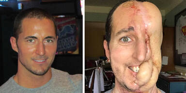 Ein Riesen-Tumor fra&szlig; sein halbes Gesicht