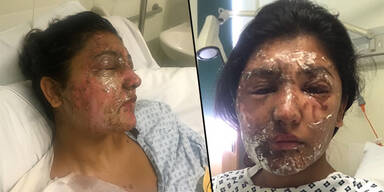 Sie wurde Opfer einer S&auml;ure-Attacke &ndash; so sieht sie heute aus