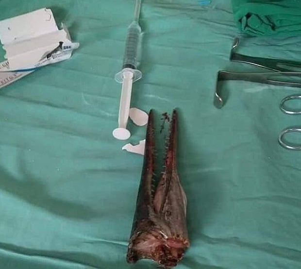 Hornhecht bohrt sich durch Hals eines 16-Jährigen