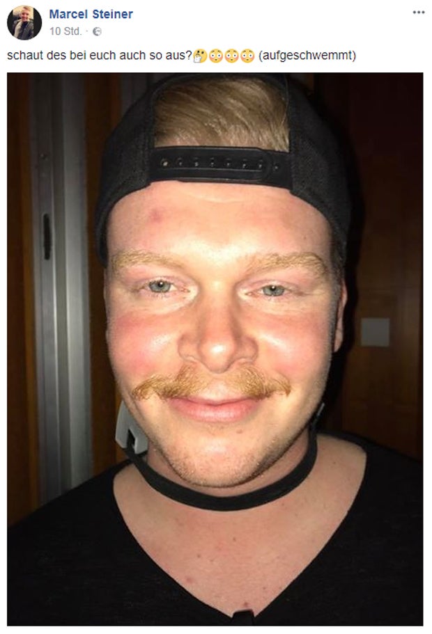 100 Erkrankte nach Faschingsfeiern