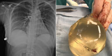 Kugel abgelenkt: Brustimplantat rettet Frau das Leben