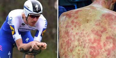 Rad-Star schockt mit Hagel-Foto