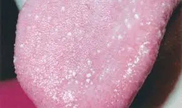 Forscher entdecken neues Corona-Symptom