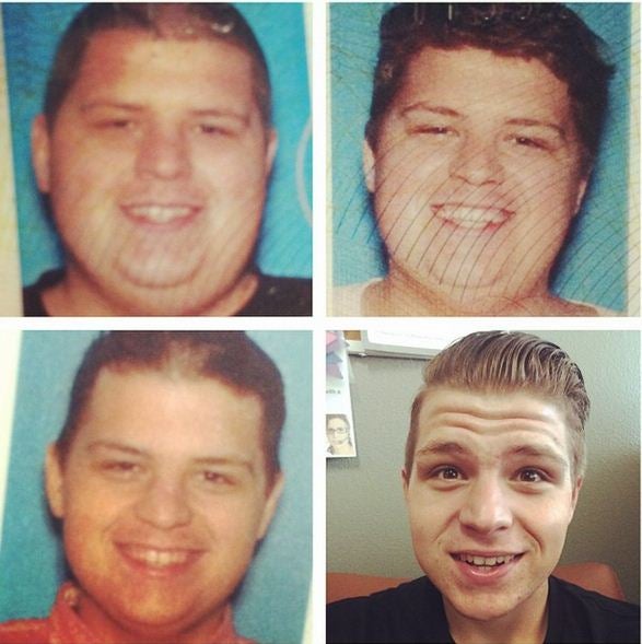 Haut nach 70 Kilo Gewichtsverlust