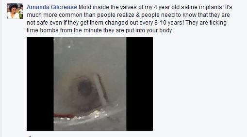 Dieser Frau schimmelten die Brüste