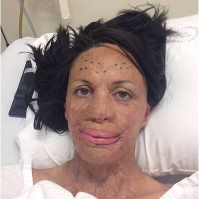 Turia Pitt