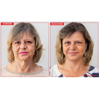 Facelifting - Vorher/Nachher Ergebnisse