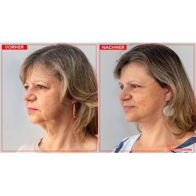 Facelifting - Vorher/Nachher Ergebnisse