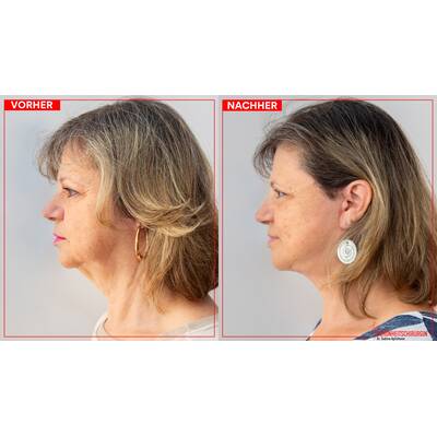 Facelifting - Vorher/Nachher Ergebnisse
