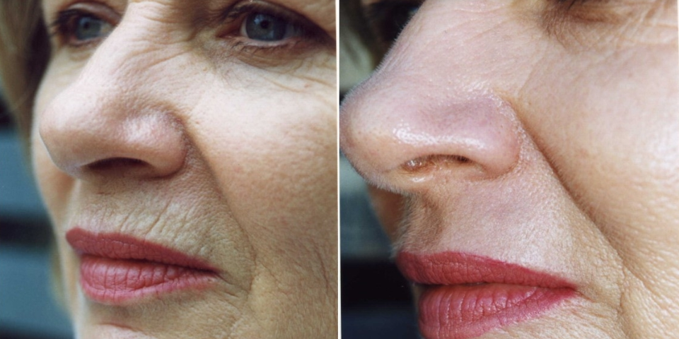 Schöne und gesunde Haut mit dem Laser