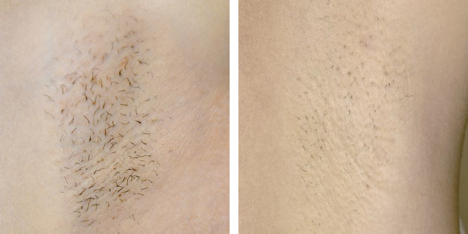 Schöne und gesunde Haut mit dem Laser