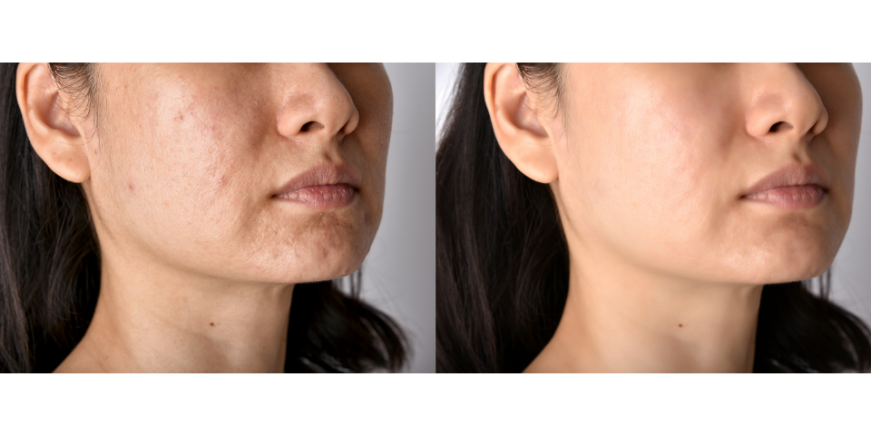 Schöne und gesunde Haut mit dem Laser