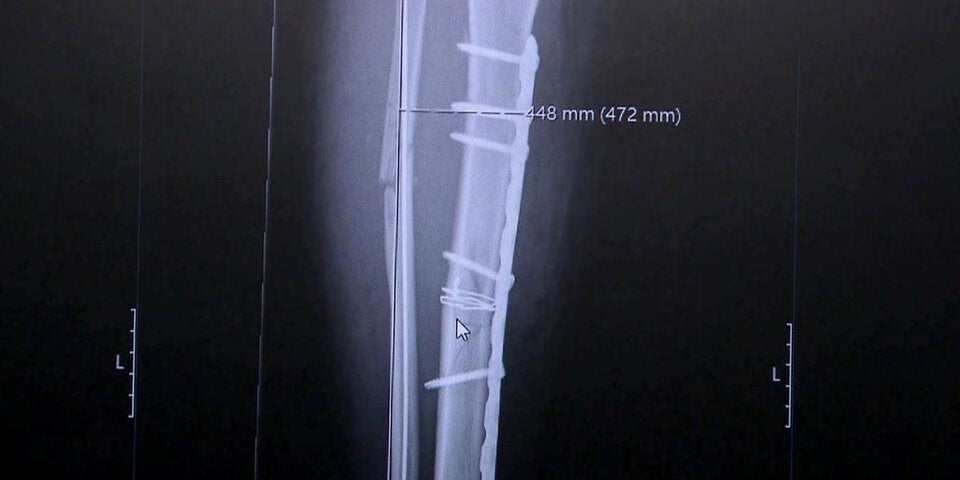 Nina Ortlieb zeigt Horrorverletzung und verspricht: 