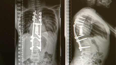 WirbelsaeulenOPInnsbruck_OR