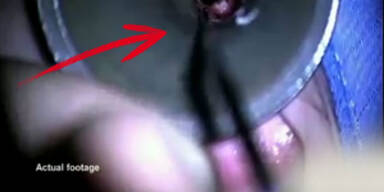 VIDEO: Zombie-W&uuml;rmer fressen sich durch Ohr