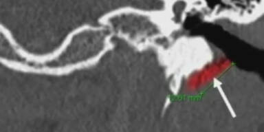 Fleischfressende  Horror- W&uuml;rmer im Ohr