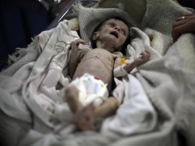 Die hungernden Babys von Syrien