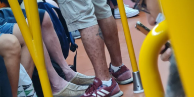 Arzt entdeckt Affenpocken-Kranken in U-Bahn – niemand reagiert