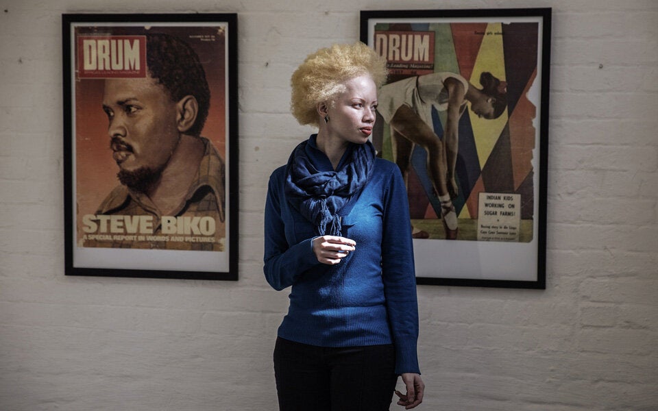 Albino-Model kämpft gegen Vorurteile