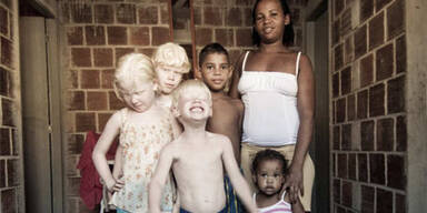 albinos_brasilien