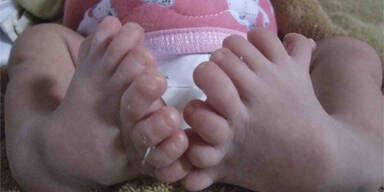 Baby mit 16 Zehen in China geboren