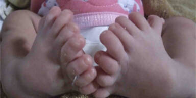 Baby mit 16 Zehen in China geboren