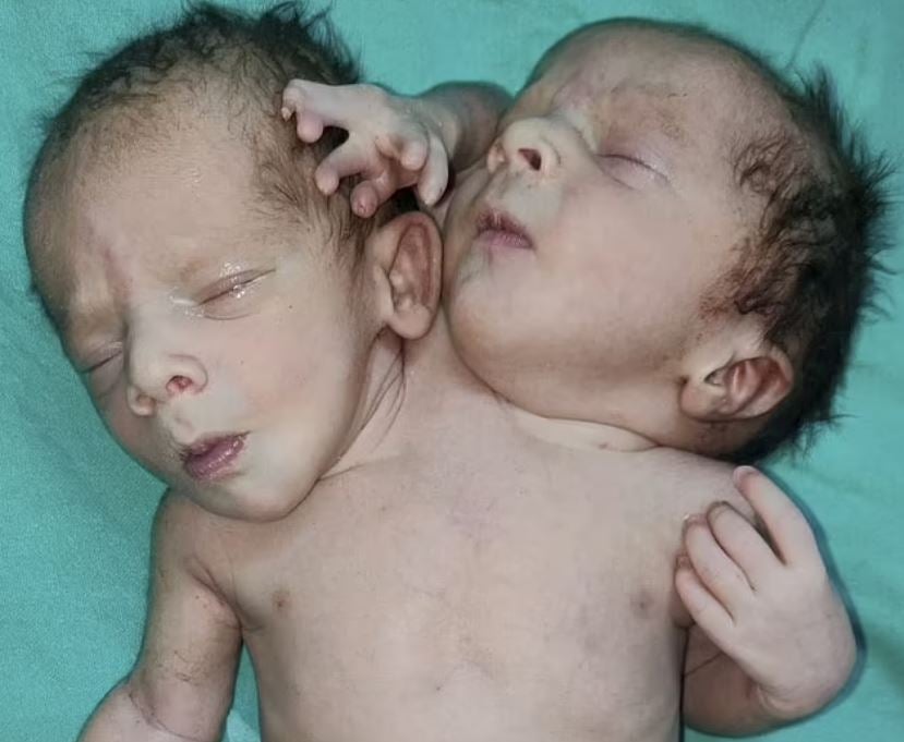 Baby mit zwei Köpfen geboren