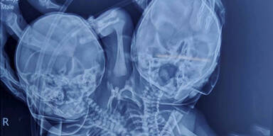 Baby mit zwei K&ouml;pfen geboren