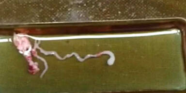 Bub hatte 8 cm langen Wurm im Kopf