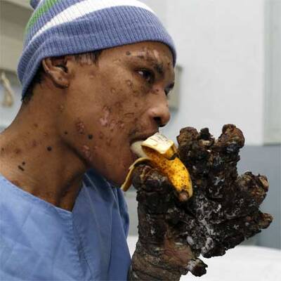 Die ersten Bilder nach der OP