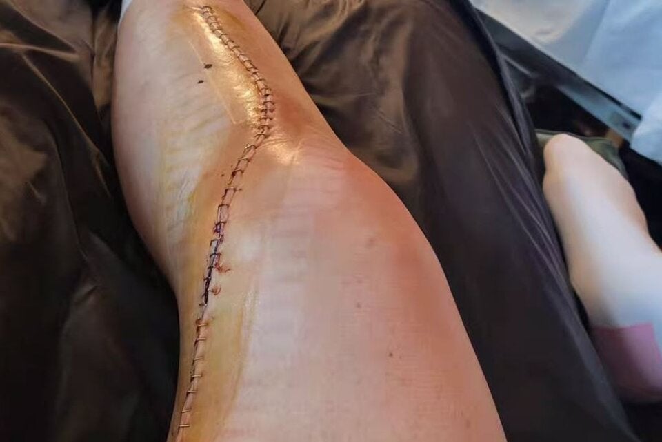 Brignone veröffentlichte Foto von operiertem Bein