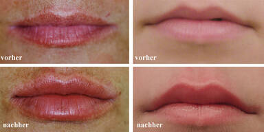 Welchen Falten kann man mit Hyaluronsäure glätten?